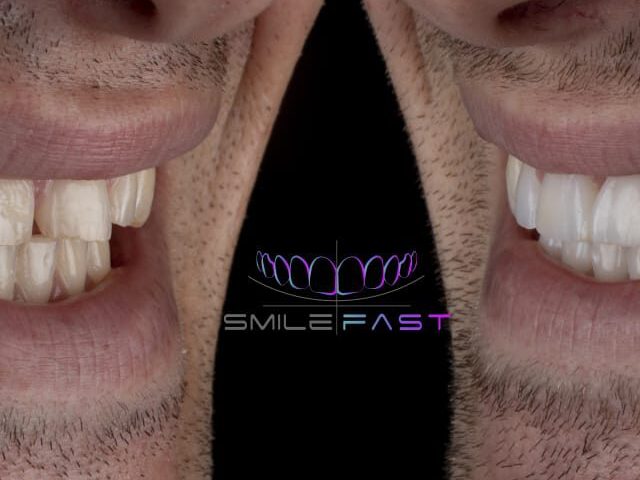 https://mydentanet.co.uk/wp-content/uploads/2021/11/Twisted-worn-down-teeth-640x487-1-640x480.jpeg